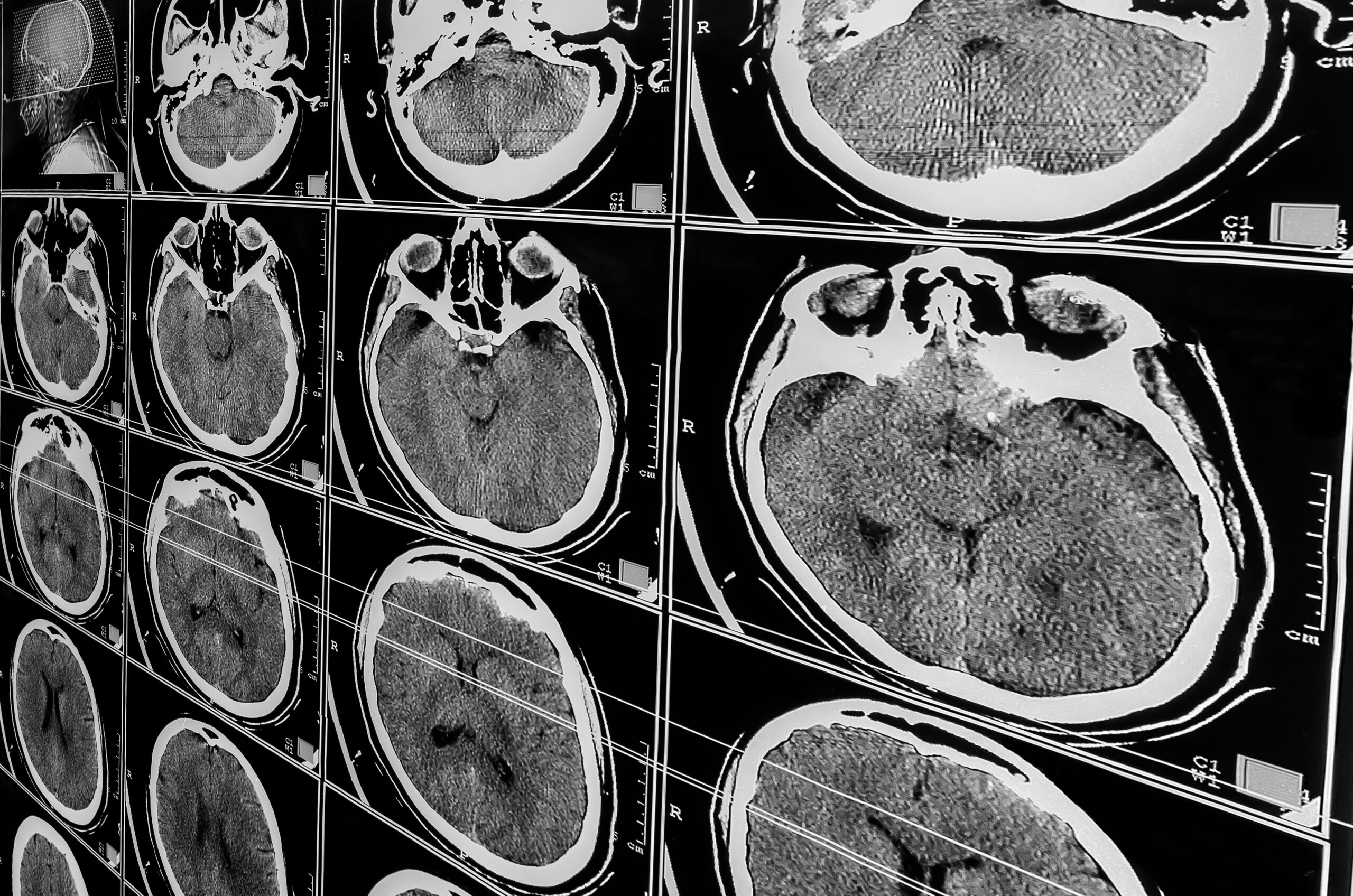 Children and Traumatic Brain Injury in Columbia, South Carolina | Law ...